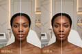 before and after photos of CrystalFrax PRO Non-Invasive Fractional RF /black woman/salon setting/luxury